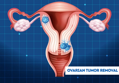 1765515669ovarian-tumor-removal