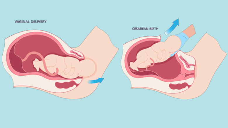 Natural-Birth-vs.-C-Section_-Making-Informed-Delivery-Choices